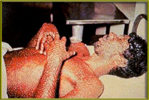 Smallpox1